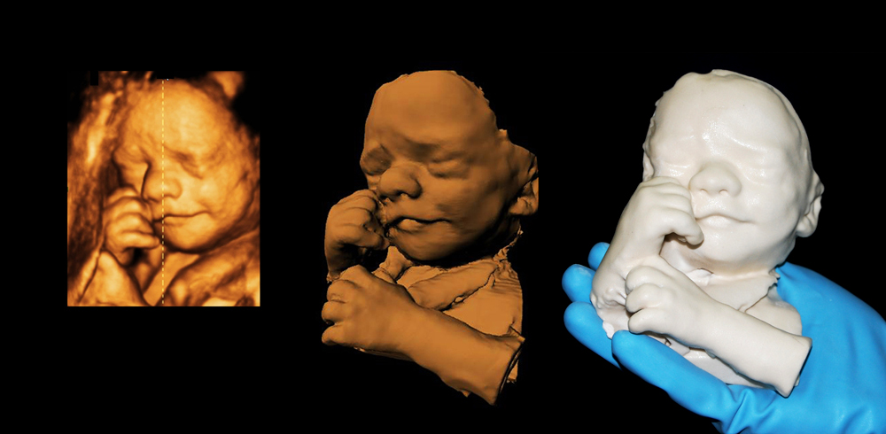 3 examples of high resolution sonogram imaging, where the facial contours of a developing fetus are clearly defined